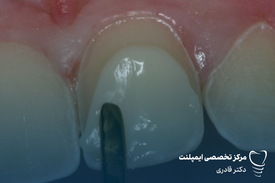 فرق لمینت و کامپوزیت دندان چیست دکتر مرتضی قادری