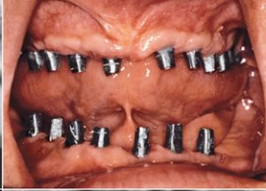 بازسازی کامل دهان با ایمپلنت