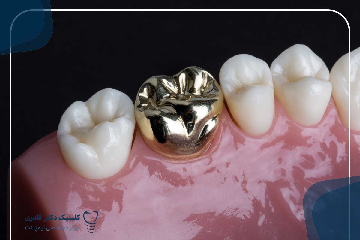چه نوع روکش‌های دندانی موجود است و چه تفاوتی بین آنها وجود دارد؟