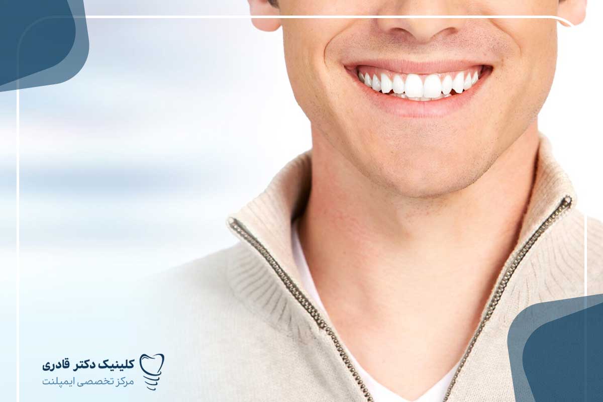 دلیل اصلی زیبایی کامپوزیت دندان