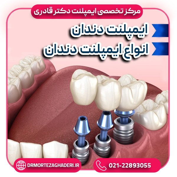 ایپملنت دندان