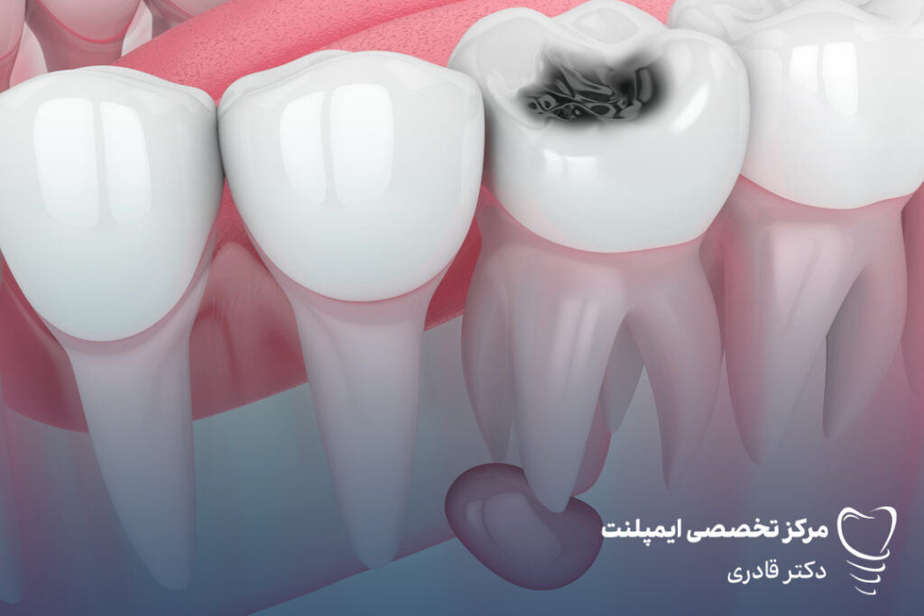 کیست دندان - چه چیزی برای کیست دندان خوب است - درمان کیست دندان در طب سنتی