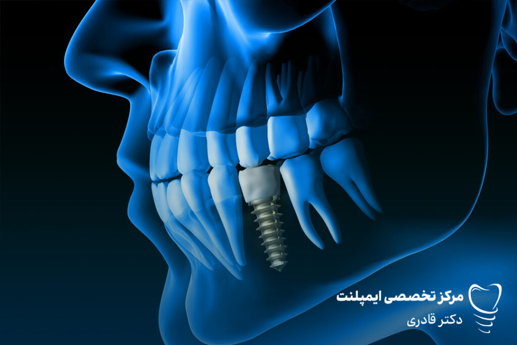 ایمپلنت دندان در گرج
