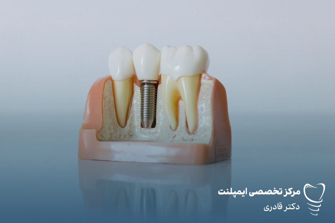 تفاوت قیمت ایمپلنت دندان