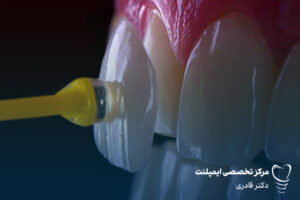 فرق لمینت و کامپوزیت دندان چیست