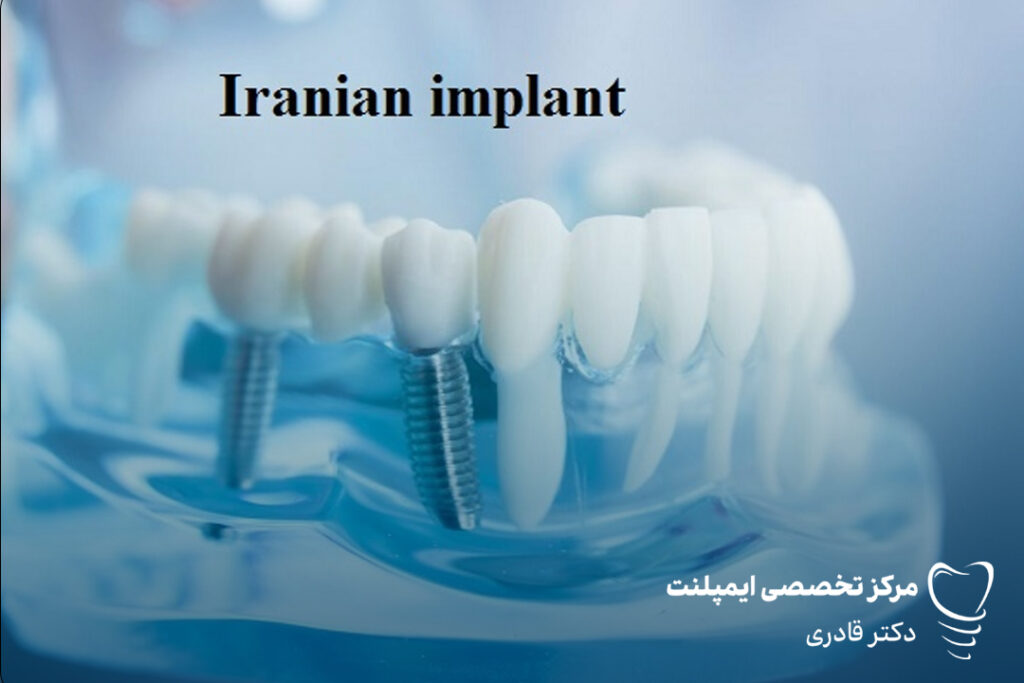 ایمپلنت ایرانی