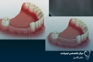 مزایای ایمپلنت دندان | مشکلات دندان مصنوعی