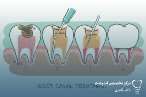 عصب کشی دندان | هزینه عصب کشی