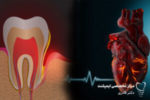آیا ایمپلنت دندان برای بیماران قلبی خطرناک است؟