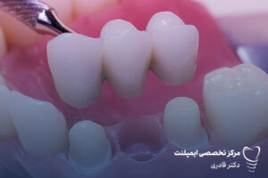 روشهای جایگزینی دندان از دست رفته 