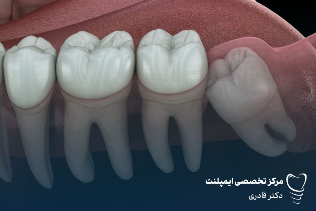 درباره علل کشیدن دندان عقل بیشتر بدانید