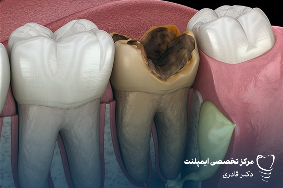 عصب دندان