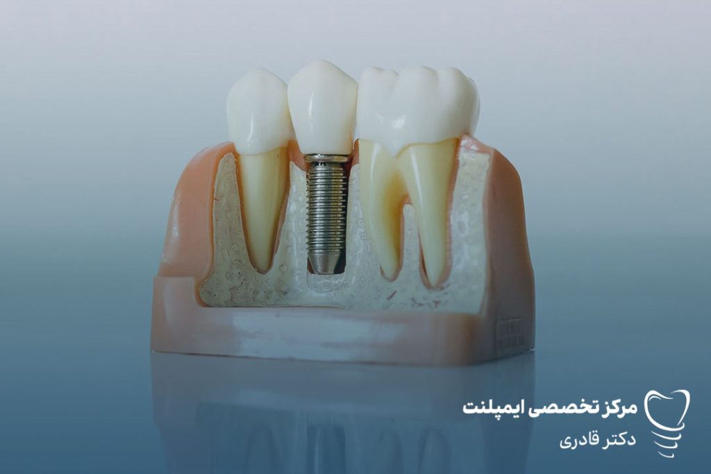 چند دندان را می‌توان ایمپلنت کرد؟