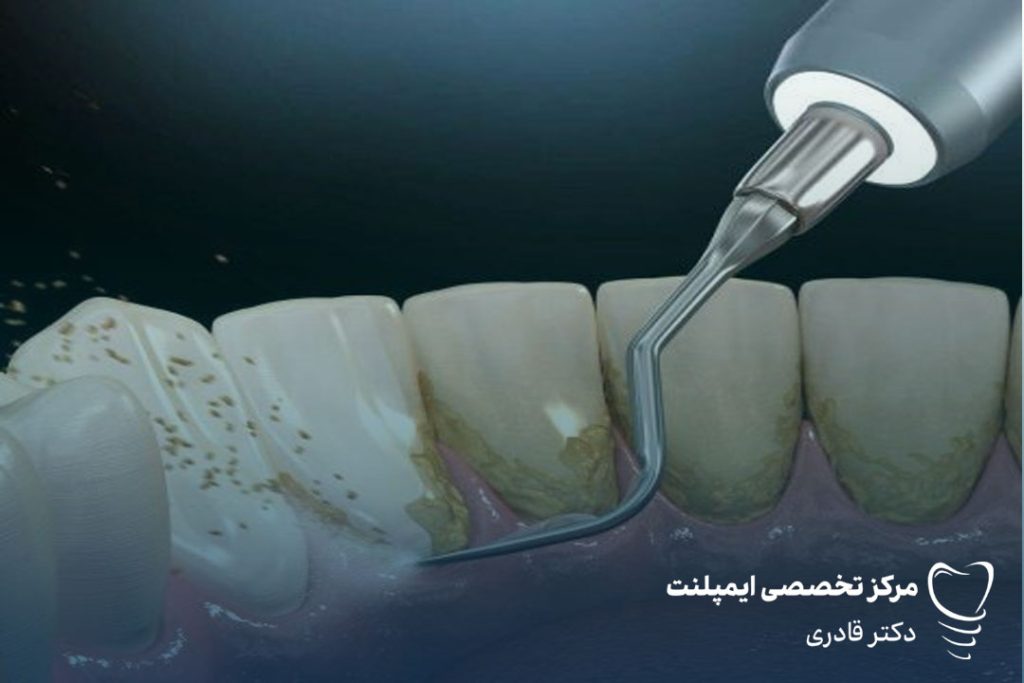 روش‌های از بین بردن جرم دندان