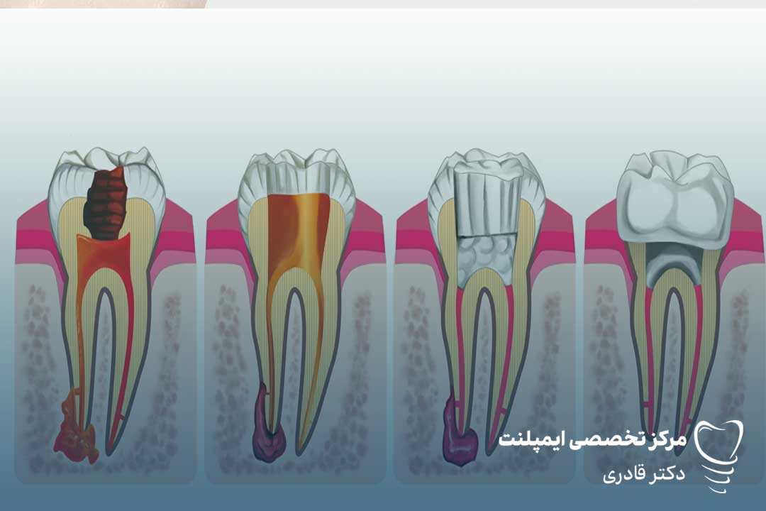 دندان عصب کشی3