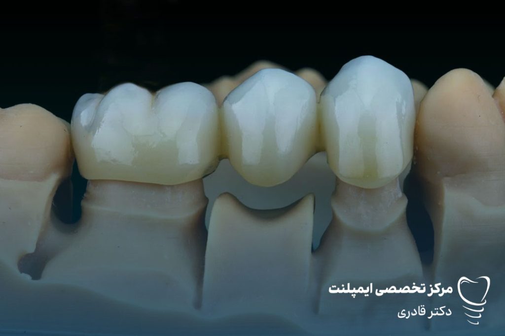 دندان عصب کشی6