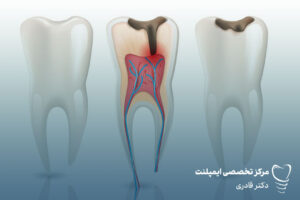 جلوگیری از پوسیدگی زودهنگام دندان