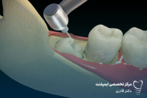 ایمپلنت دندان عقل