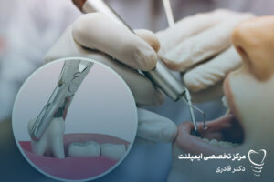 کشیدن دندان عقل به توصیه دندانپزشکان