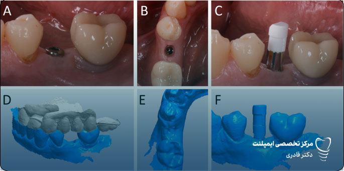 هوش مصنوعی در کاشت ایمپلنت دندان