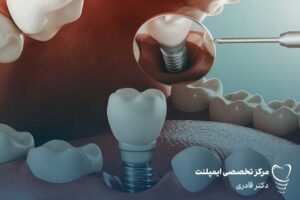 تاثیرات عفونت پریودنتال بر کاشت ایمپلنت دندان