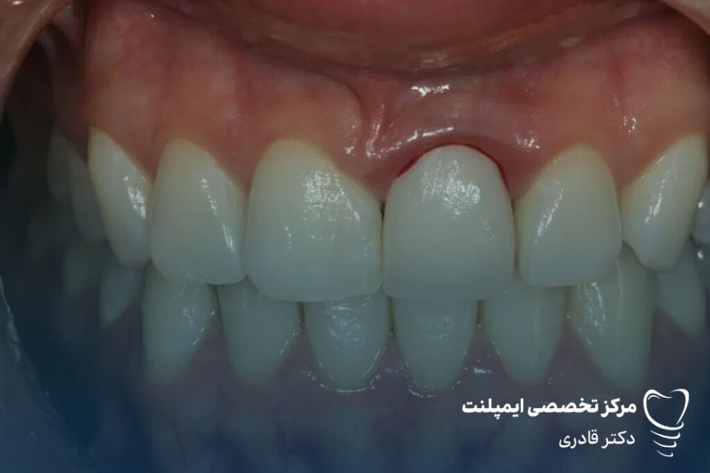 پیشگیری از عفونت تاج دندان
