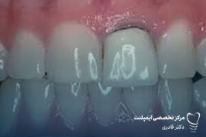 پیشگیری از عفونت تاج دندان برای حفظ لبخند