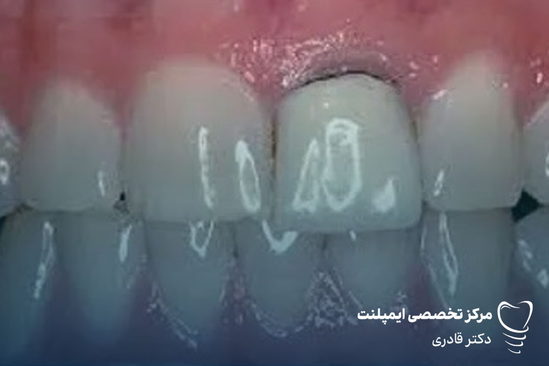 پیشگیری از عفونت تاج دندان برای حفظ لبخند