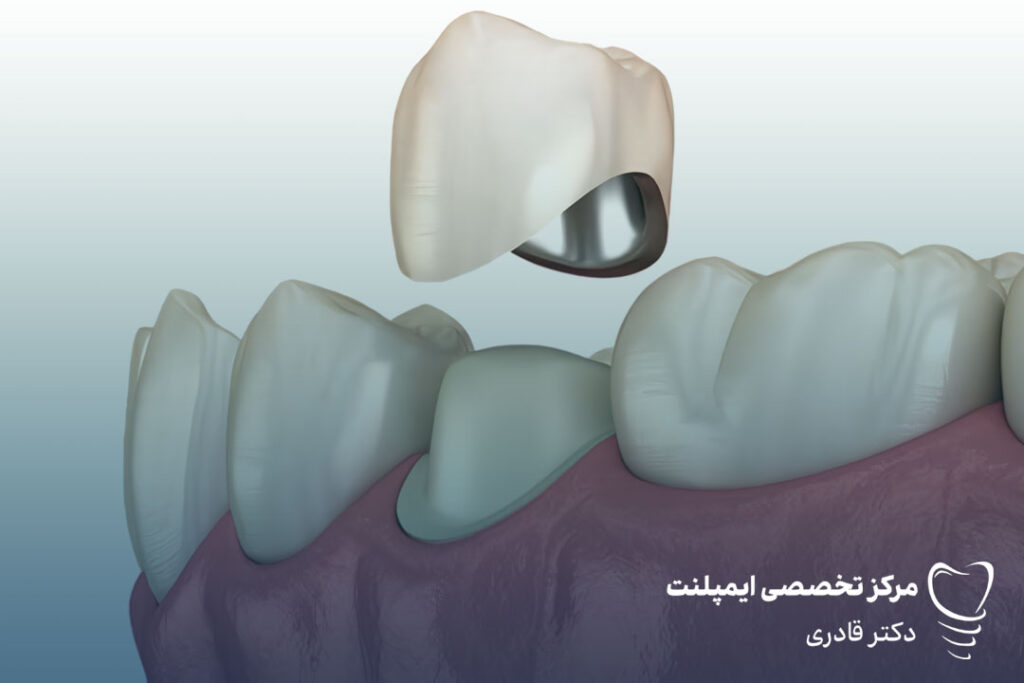 پیشگیری از عفونت تاج دندان