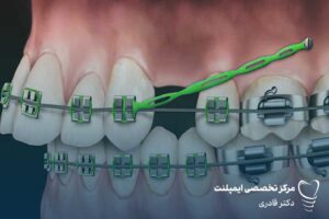 جای خالی دندان کشیده شده در ارتودنسی پر می شود؟