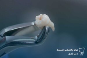 مراقبت بعد از کشیدن دندان عقل