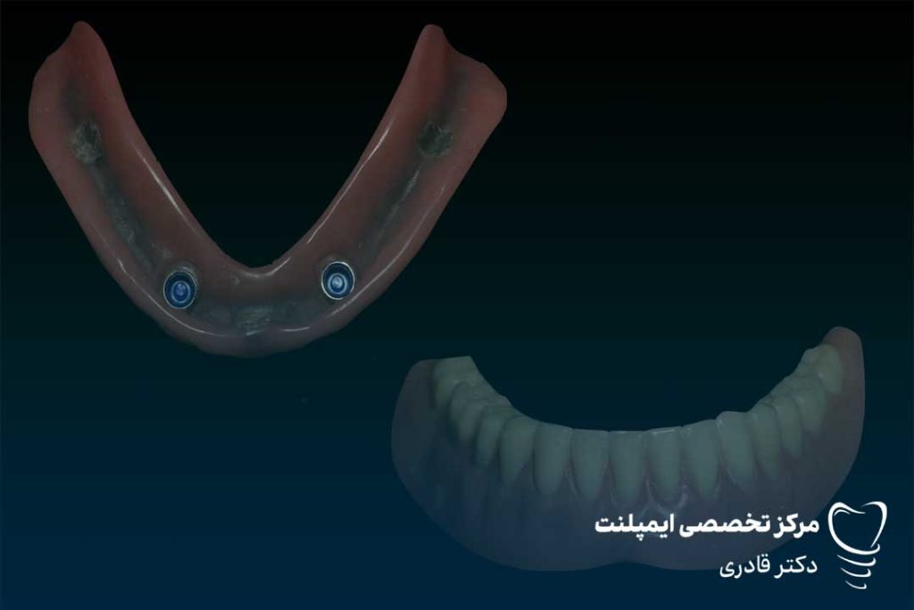 قیمت اوردنچر بر پایه ایمپلنت