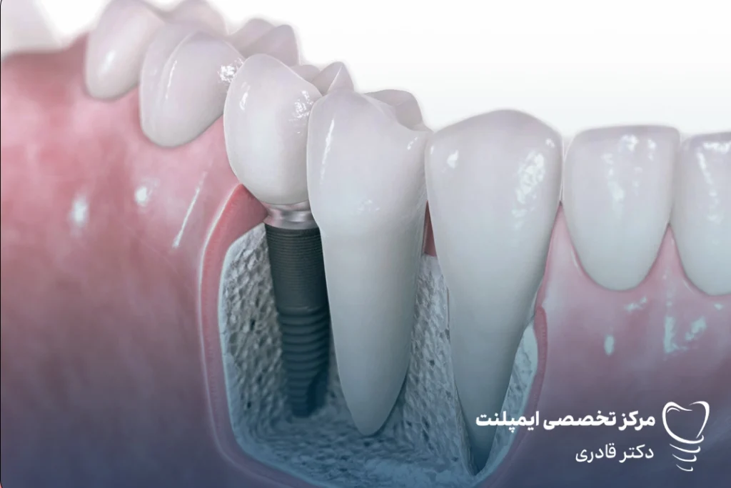 ایمپلنت دندان کودکان