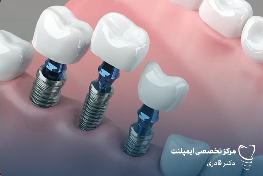 ایمپلنت دندان در کودکان