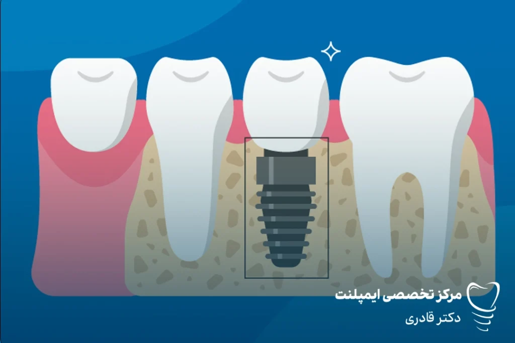 ایمپلنت دندان کودکان