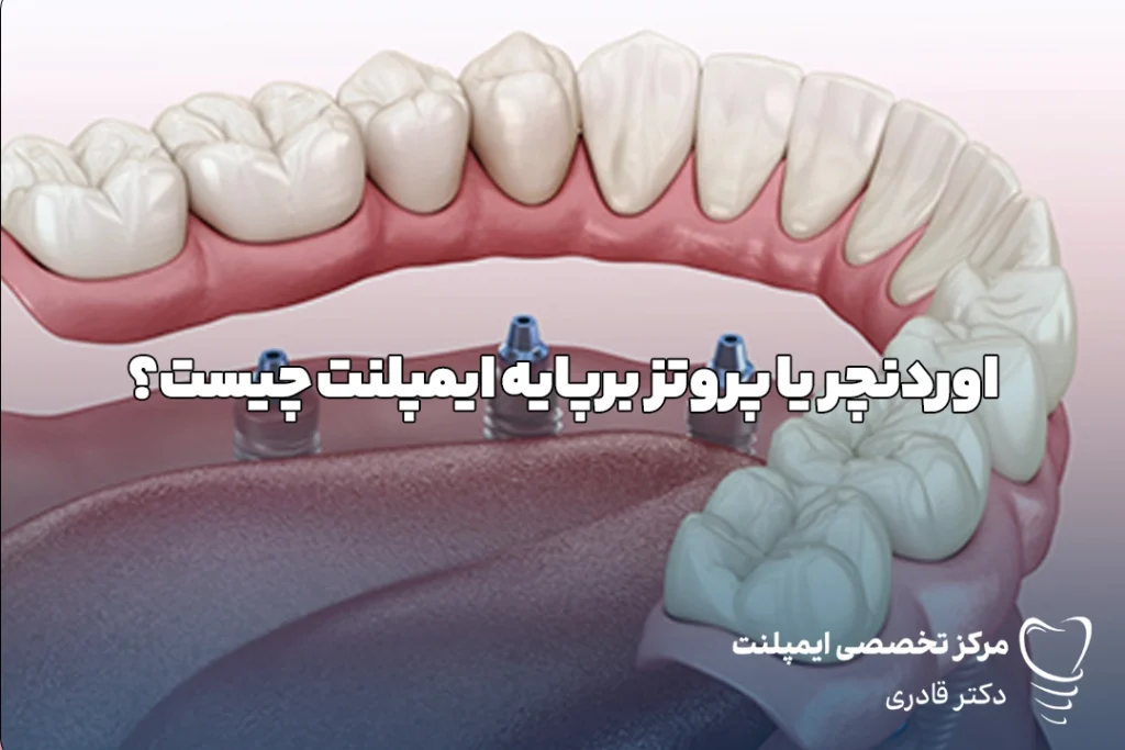 اوردنچرچیست؟