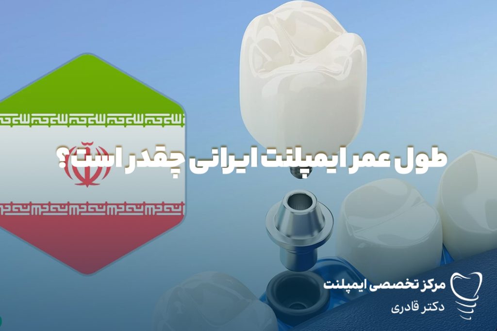 طول عمر ایمپلنت ایرانی