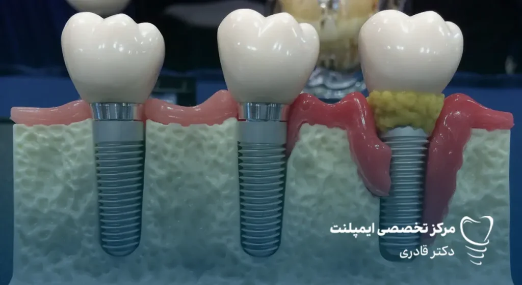 عمر ایمپلنت سوئیسی