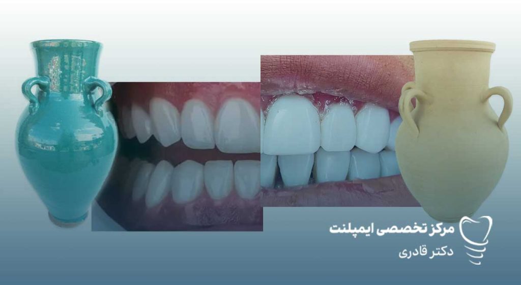 تفاوت ظاهری لمینت و کامپوزیت