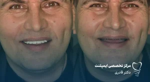 ایمپلنت کامل فک بالا و پایین