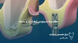 مقالات 36 تفاوت سینوس لیفت باز و بسته