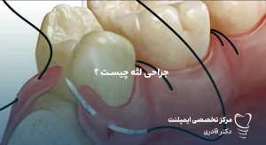 جراحی لثه چیست
