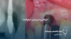 مقالات 46 درمان پس زدن ایمپلنت