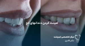 مقالات 44 دندان کج - صاف کردن دندان کج جلو