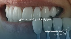 مقالات 43 رنگ لمینت دندان