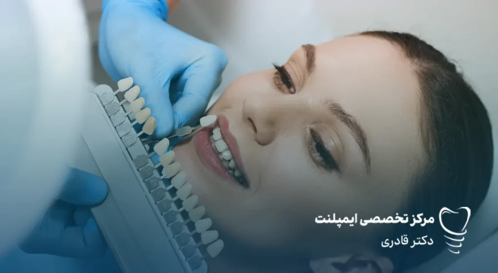 رنگ لمینت دندان