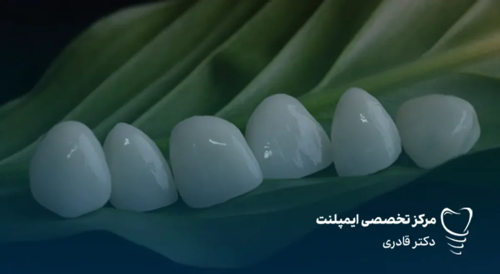 رنگ لمینت دندان