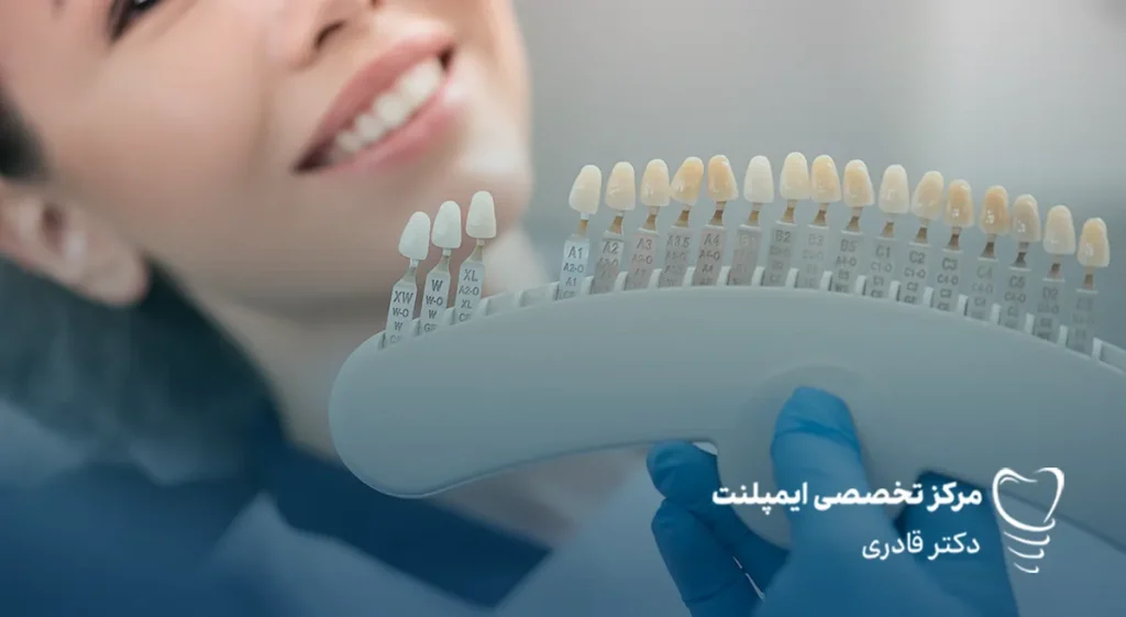 رنگ لمینت دندان