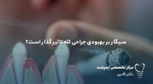 مقالات 35 تاثیر سیگار بر جراحی لثه