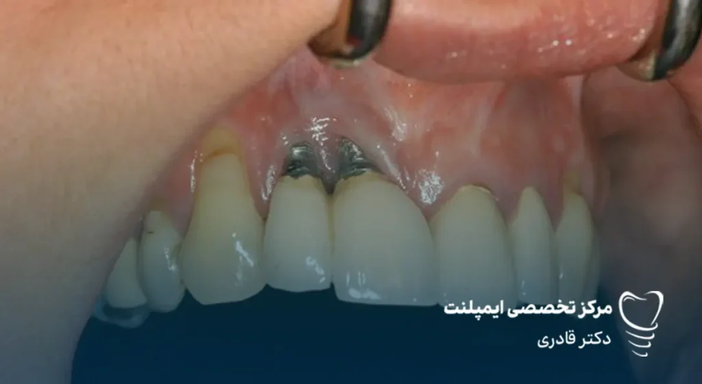عکس پس زدن ایمپلنت